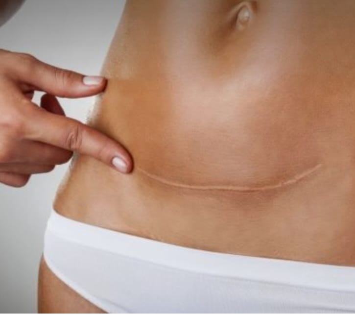 Ventre avec cicatrice